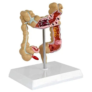 Модель патологического рака толстой кишки Модель колоректального рака Анатомическая модель желудочно-кишечного тракта